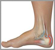 Achilles Tendon Bursitis