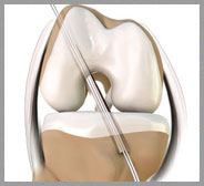  ACL Reconstruction 