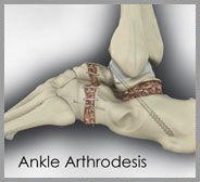  Ankle Arthrodesis