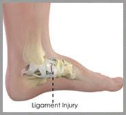 Ankle Ligament Injury