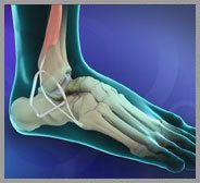  Ankle Ligament Reconstruction