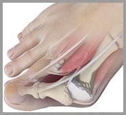 Bunion Surgery 