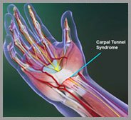 Carpal Tunnel Syndrome