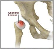 Chondral Lesions or Injuries