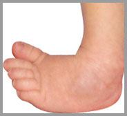 Club foot and Congenital Deformity