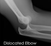 Elbow Dislocation