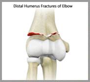 Distal Humerus Fractures of the Elbow