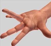 Dupuytren’s Contracture