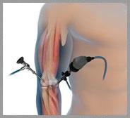 Elbow Arthroscopy