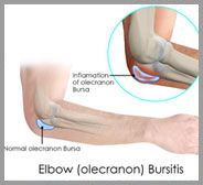 Elbow (Olecranon) Bursitis