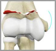 Elbow Fractures