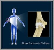 Elbow Fractures in Children
