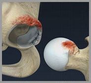 Femoroacetabular Impingement