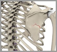 Fracture of the Shoulder Blade