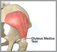 Gluteus Medius Tear