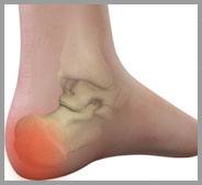 Heel Pain