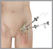 Hip Arthroscopy