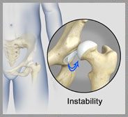 Hip Instability