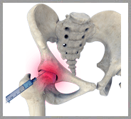 Hip Injections 
