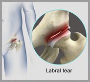 Hip Labral Tear