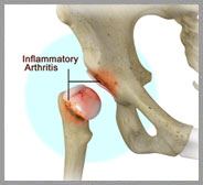Inflammatory Arthritis of the Hip 