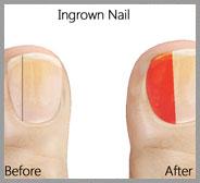 Ingrown Toenail