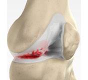  Knee Arthritis  