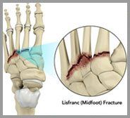 Lisfranc (Midfoot) Fracture