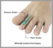  Minimally Invasive Foot Surgery 