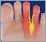 Morton's Neuroma