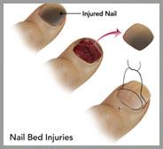 Nail Bed Injuries