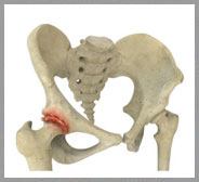 Osteoarthritis of the Hip 