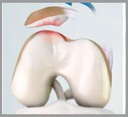  Patellar Dislocation/Patellofemoral Dislocation  