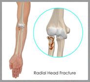 Radial Head Fractures of the Elbow