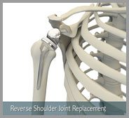 Reverse Shoulder Replacement