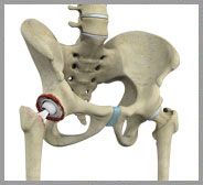 Revision Hip Replacement