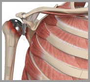 Revision Shoulder Replacement