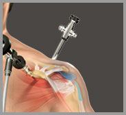 Shoulder Arthroscopy