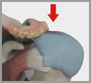 Shoulder Impingement