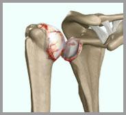 Arthritis of the Shoulder