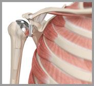 Shoulder Joint Replacemen