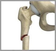  Subtrochanteric Hip Fracture 