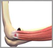 Tennis Elbow