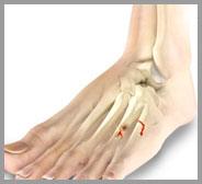 Toe and Forefoot Fractures