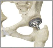 Total Hip Replacement