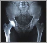 Transient Osteoporosis of the Hip 