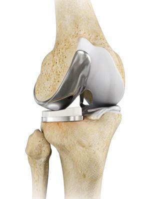  Unicompartmental Knee Replacement     