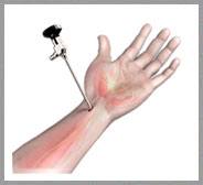 Wrist Arthroscopy