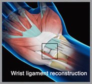 Wrist Ligament Reconstruction
